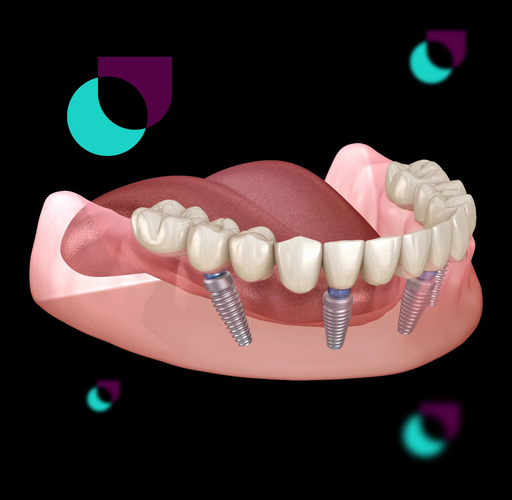 Implante dentário — tecnologia digital Oral Unic